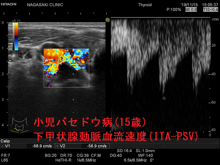 小児バセドウ病（15歳）超音波(エコー)画像　下甲状腺動脈血流(ITA-PSV)