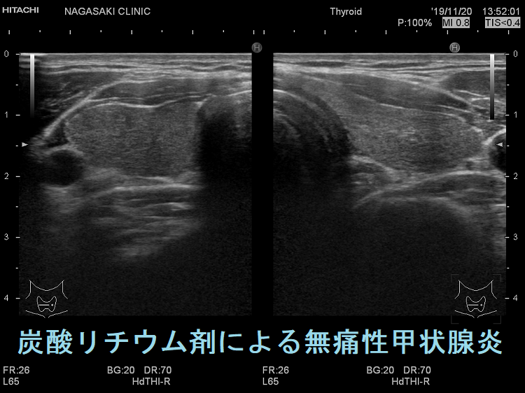 炭酸リチウム剤による無痛性甲状腺炎 超音波(エコー)画像
