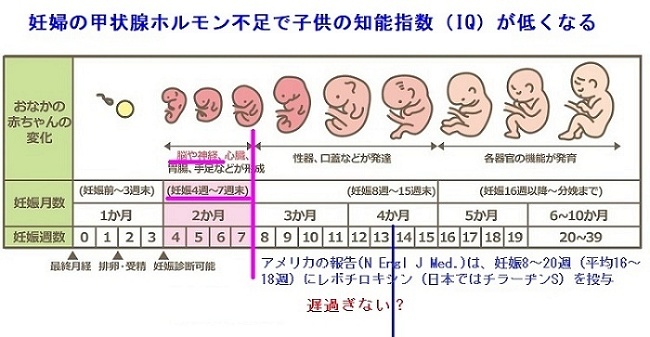 妊婦の甲状腺ホルモン不足で子供の知能指数(IQ)が低くなる
