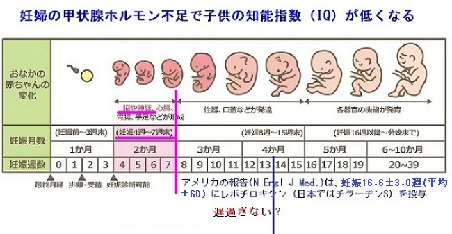 妊婦の甲状腺ホルモン不足で子供の知能指数（IQ）が低くなる